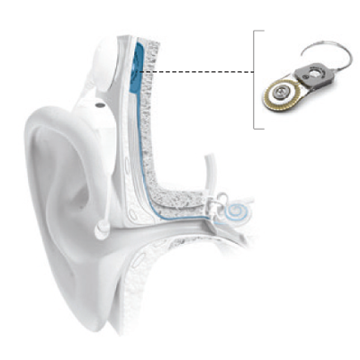 hi tone hearing ab bionics 2